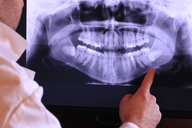 Best Knocked-Out Tooth (Avulsed Tooth) Treatment in Bertsch Oceanview, CA
