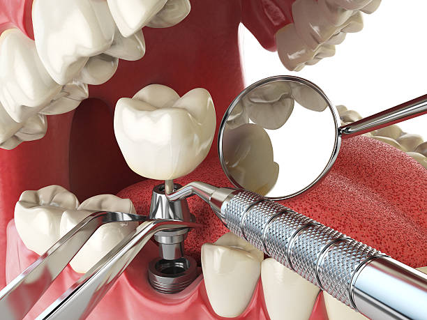 Best Broken or Chipped Tooth Repair in Bertsch Oceanview, CA